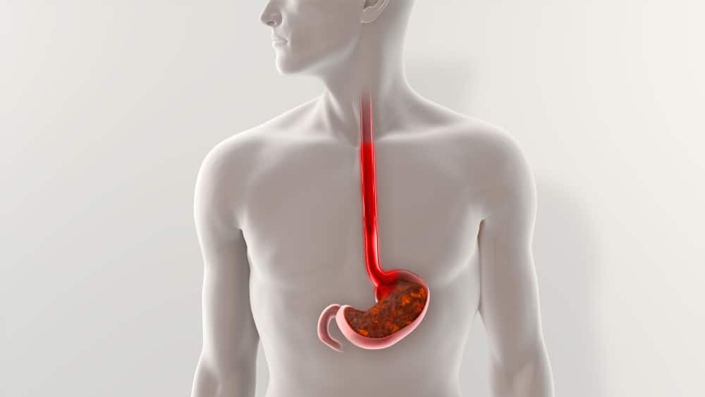 What Causes Acid Reflux?